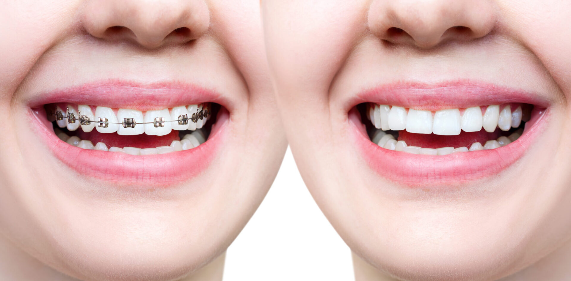 Braces and Clear Aligners