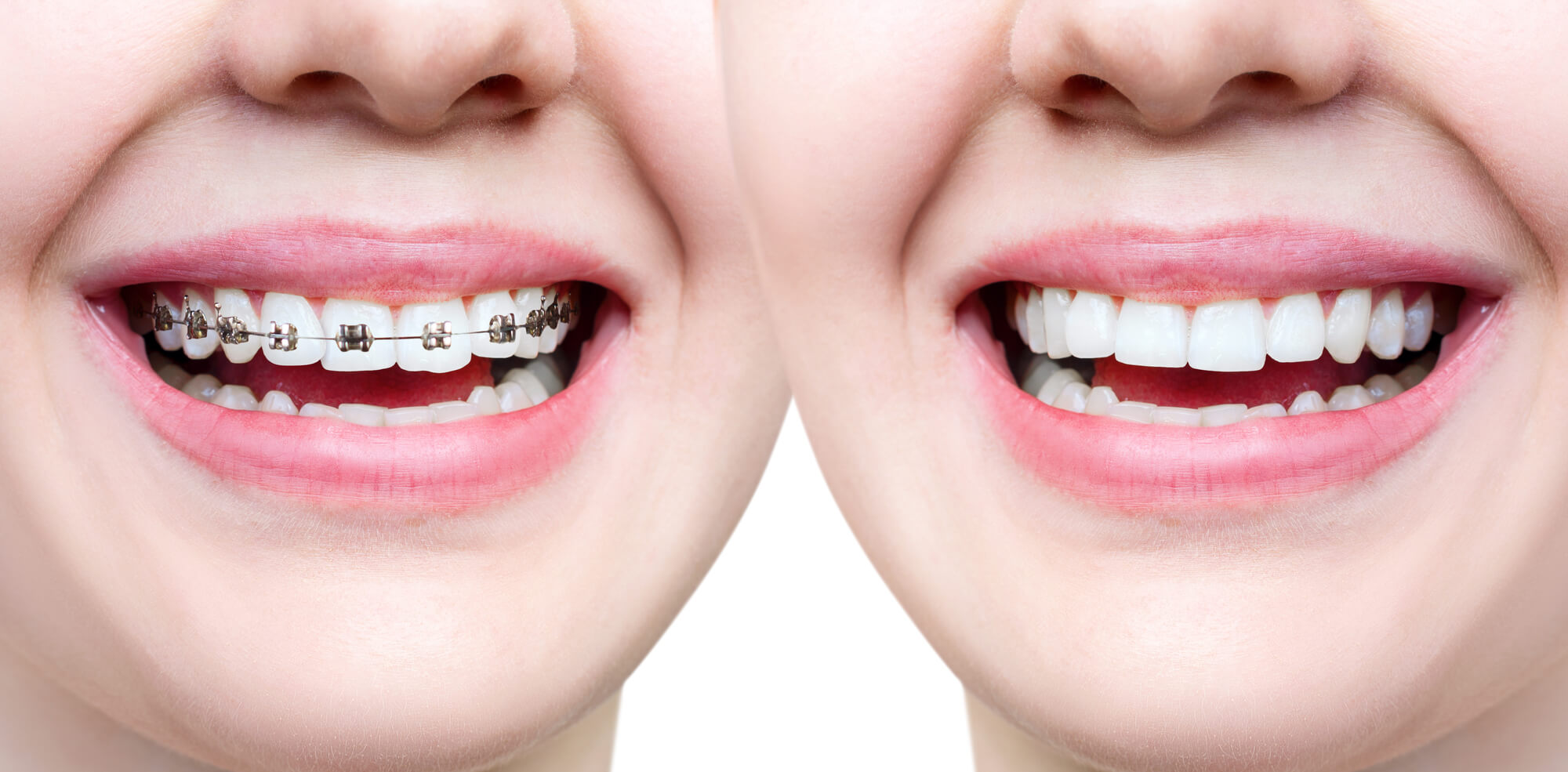 The Benefits of Braces and Clear Aligners | Dentist Ontario, CA ...