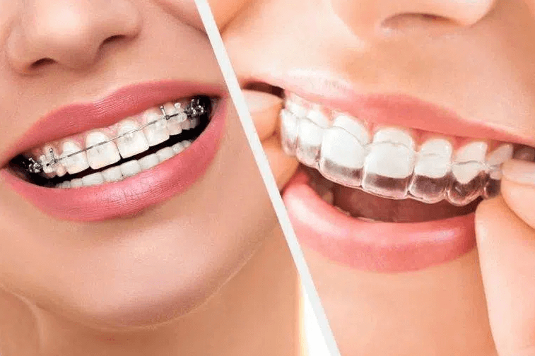 Achieving a Perfect Smile: The Benefits of Braces and Clear Aligners