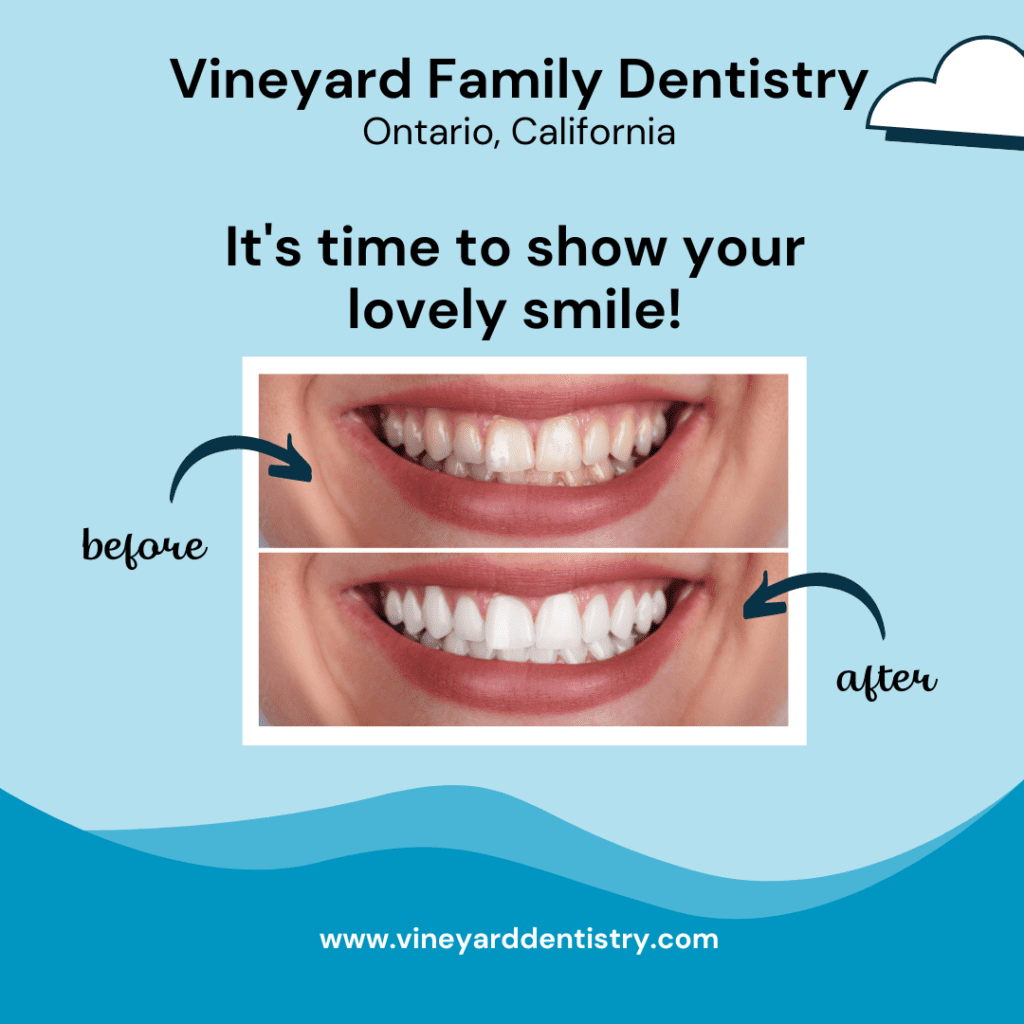 Teeth Whitening Ontario